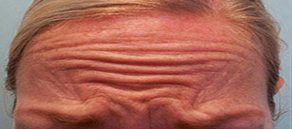 Botox and Dysport