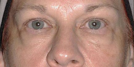 Non-Invasive Skin Rejuvenation