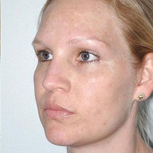 Corrective Chemical Peels