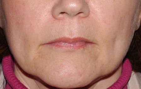 Juvederm