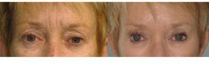 Botox treatments to reduce their appearance