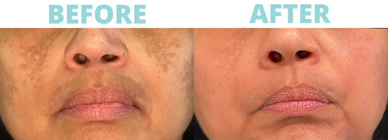 Discover the Sciton Moxi Laser: A Gentle Way to Rejuvenate Your Skin