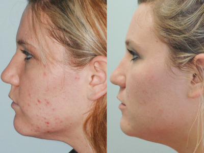Acne in Greensboro, North Carolina