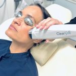 MicroLaserPeel