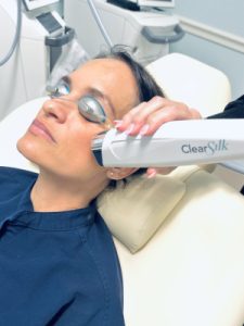 MicroLaserPeel